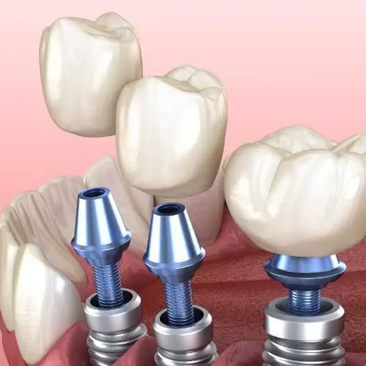 dental implants sidcup