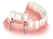 implant supported bridge