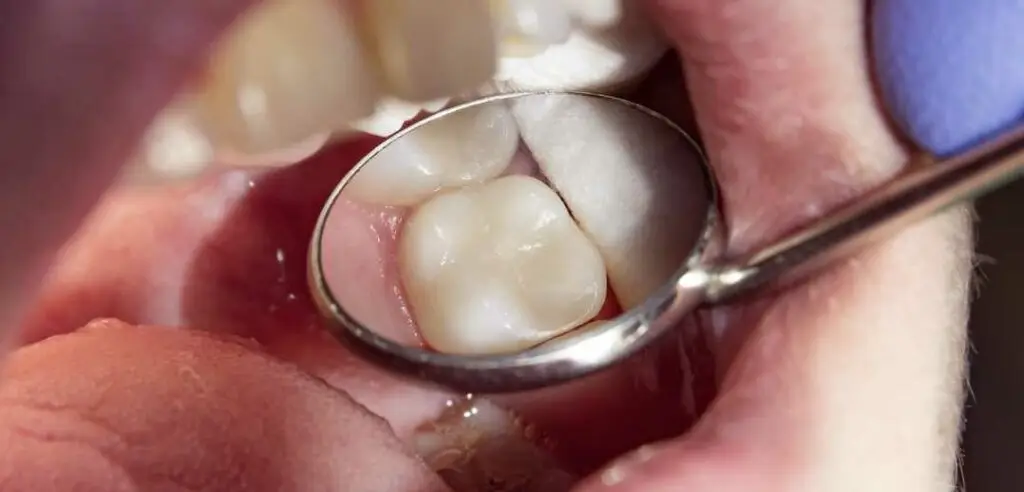 Close-up of a tooth with a glass ionomer filling, reflected in a dental mirror during an examination.