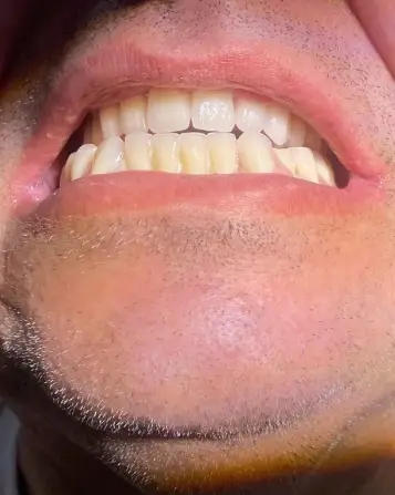 Dental Implants After