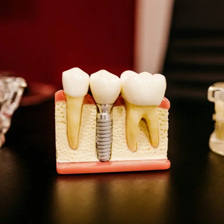 Private Dental Implants