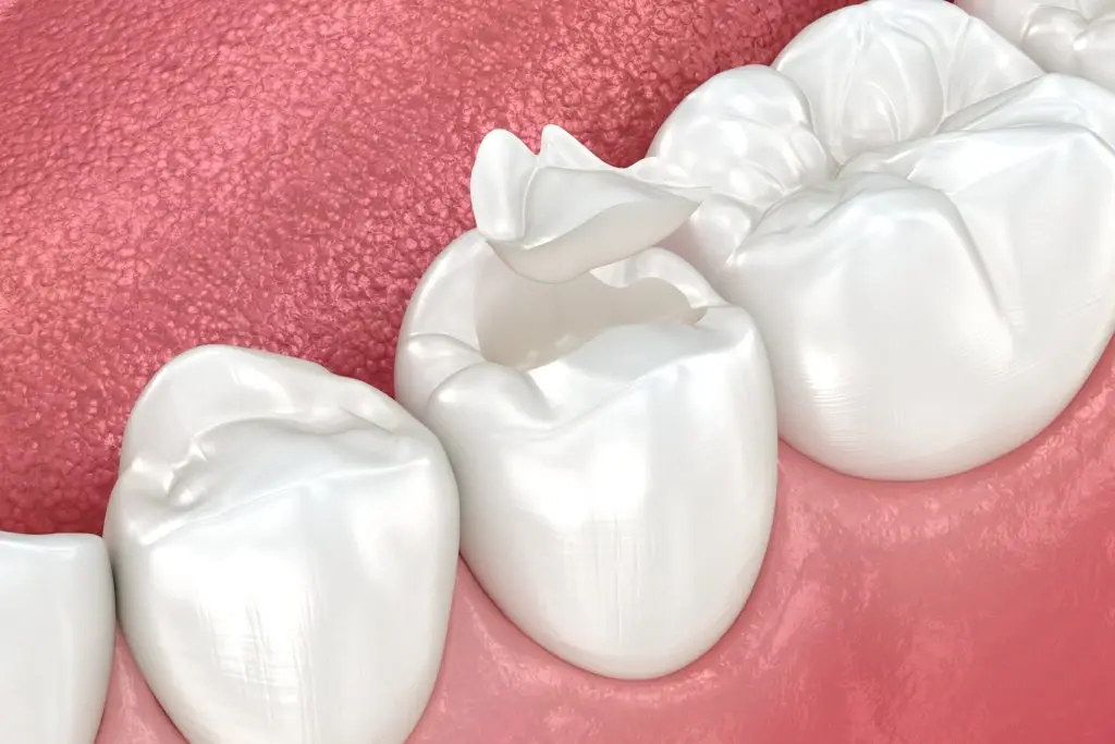 Dental caps are custom-made restorations that fit over a prepared tooth