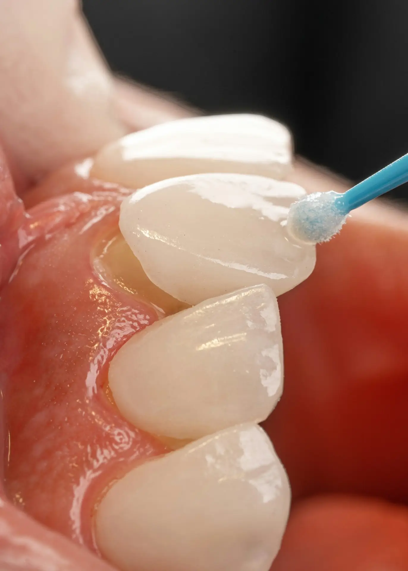 Veneers offer a multitude of advantages